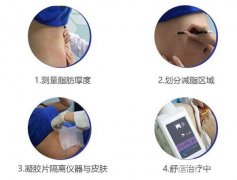 MPX双频微创溶脂，s曲线看得到!