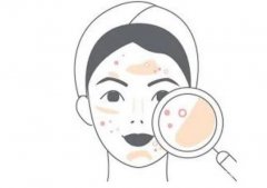 点阵激光有什么优势 ，做点阵激光会痛吗