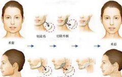 垫下巴用什么材料好，要多久才能完全恢复
