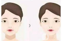 面部适合做水动力吸脂吗