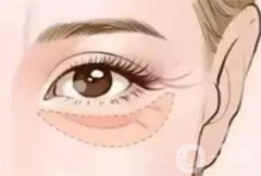 去黑眼圈手术效果怎么样?