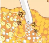 吸脂手术方法有哪些，吸脂可以减掉多少斤