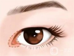 眼窝凹陷的原因有哪些，有哪些填充眼窝的方法