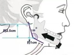 影响削颧骨后愈合的因素有哪些?