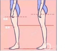 电动负压吸脂方法和操作步骤