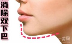 垫下巴方法有哪些?每种垫下巴方法的适合人群以及术后注意事项