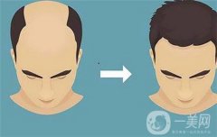 植发后如何正确洗头，你想知道的都在这~