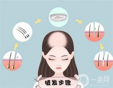 植发后，如何在家做好日常护理?需要用药吗?