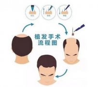 植发后还需要吃药吗?要吃多长时间?