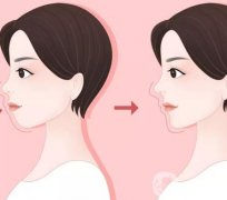 嘴凸会不会导致法令纹加重?矫正牙齿后会有改良吗?