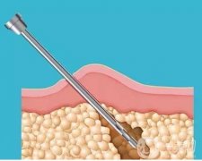 冷触雷射溶脂，针对瘦脸、身材雕塑更有针对性!