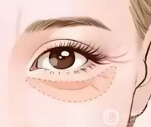 泪沟——暗戳戳在拉低你的颜值