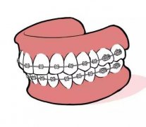 烤瓷牙套里的牙会烂吗