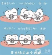 烤瓷牙套能用多久