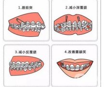 牙齿矫正会改变脸型么