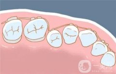 牙齿矫正价格表和方法