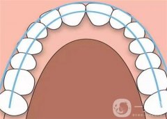 牙齿矫正需要多长时间能结束
