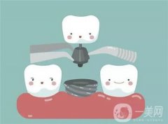 种植牙多少钱一般