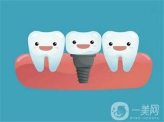 种植牙好多钱一颗