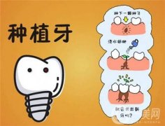 种植牙价格表一览表