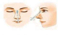 鼻尖可以注射玻尿酸吗?鼻尖注射玻尿酸有什么危害