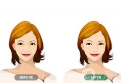 全脸拉皮术能保持多久