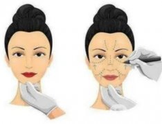 为什么拉皮后人变难看了