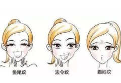 医院除皱现在好的方法（附详细介绍）
