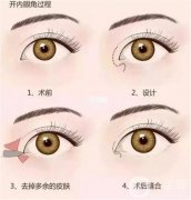 哪些因素会影响切开双眼皮的肿胀时间