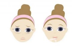 40岁眼皮松弛下垂好解决方法