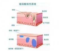 玻尿酸在护肤哪一步骤