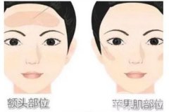 面部吸脂后遗症有哪些