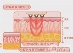 热玛吉四代和五代的区别