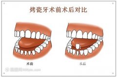烤瓷牙的价格是由多个因素决定的