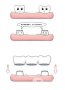 烤瓷牙的种类主要有哪些