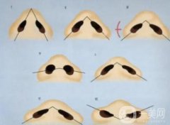 鼻翼内切会导致增生吗？留下疤痕怎么办？