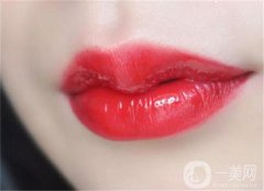 玻尿酸丰唇有什么优势？丰唇后肿胀消退需要多长时间