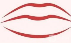 嘴角提升手术的方法有哪些？