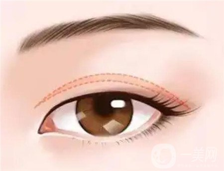 长沙张姣姣双眼皮手术：技术与性价比的完美结合！
