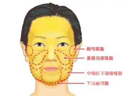 北京艺星仇侃敏隆鼻失败修复+面部吸脂手术日记分享