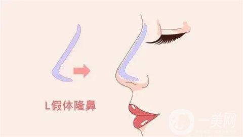 上海艺星许炎龙鼻头缩小+硅胶隆鼻真人案例大公开