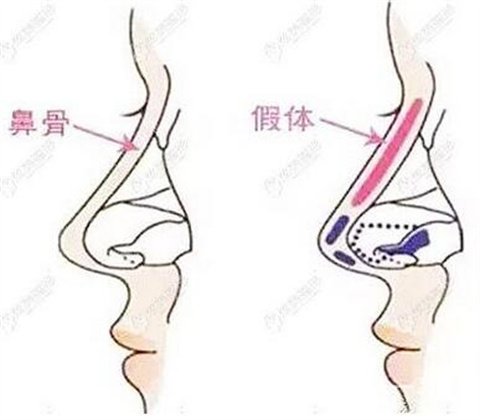 成都星尚美医学美容医院李丛丛鼻部手术六十天恢复记录