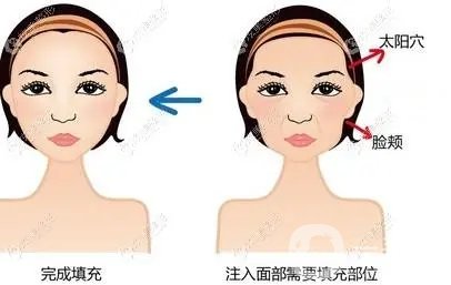 肋软骨隆鼻+全脸自体脂肪填充手术*果照片大分享