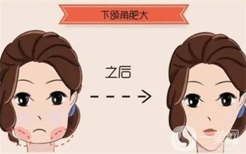 削下颌角+鼻部手术两个月真人恢复记录，附术前术后图