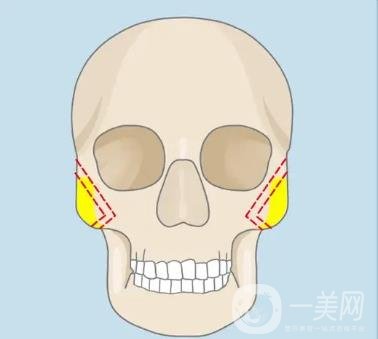 颧骨降低术后 恢复日记全记录 小脸出镜无压力