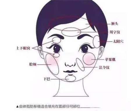 上海百达丽医疗美容张程面部脂肪填充恢复案例