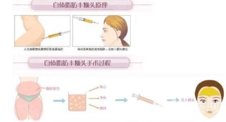 上海百达丽医疗美容张程面部脂肪填充恢复案例