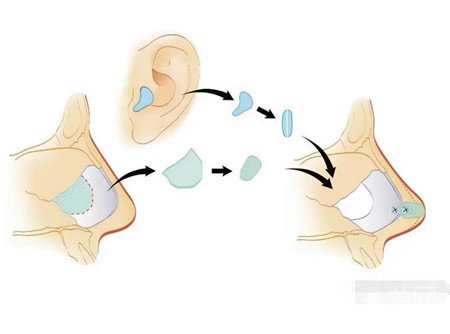 硅胶隆鼻真人案例分享，附过程及恢复步骤