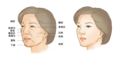 重庆爱思特自体脂肪填充全脸术后日记曝光，瘦脸又减龄！