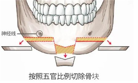 磨骨瘦脸真人案例曝光